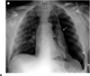 Barotrauma events separated by 14 days. 64-year-old man with diabetes and hypertension, intubated 4 days post admission. (a) Frontal chest radiograph demonstrates a large left pneumothorax 6 days after intubation (arrow). (b) He developed a large right pneumothorax 14 days later, 20 days after intubation. There is a left pleural pigtail catheter (black arrow) and re-expansion of the left lung. He underwent tracheostomy 11 days after intubation. Note hazy interstitial densities throughout his lungs.