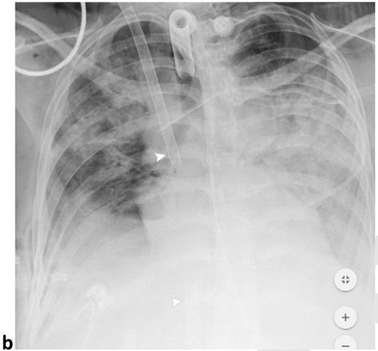 Pneumomediastinum and Bilateral Pneumothoraces, Separated by 7 days. 20-year-old woman intubated 5 days after admission. (a) Frontal chest radiograph depicts moderate pneumomediastinum (black arrows) and subcutaneous emphysema. (b) Frontal radiograph 3 days later demonstrates resolution of pneumomediastinum, and persistent mild subcutaneous emphysema. The superior and inferior extracorporeal membrane oxygenation catheters (arrowheads) were placed the preceding day. (c). Four days later, she developed large bilateral pneumothoraces (white arrows), and extensive subcutaneous emphysema.