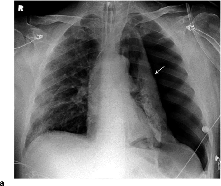 Barotrauma events separated by 14 days. 64-year-old man with diabetes and hypertension, intubated 4 days post admission. (a) Frontal chest radiograph demonstrates a large left pneumothorax 6 days after intubation (arrow). (b) He developed a large right pneumothorax 14 days later, 20 days after intubation. There is a left pleural pigtail catheter (black arrow) and re-expansion of the left lung. He underwent tracheostomy 11 days after intubation. Note hazy interstitial densities throughout his lungs.