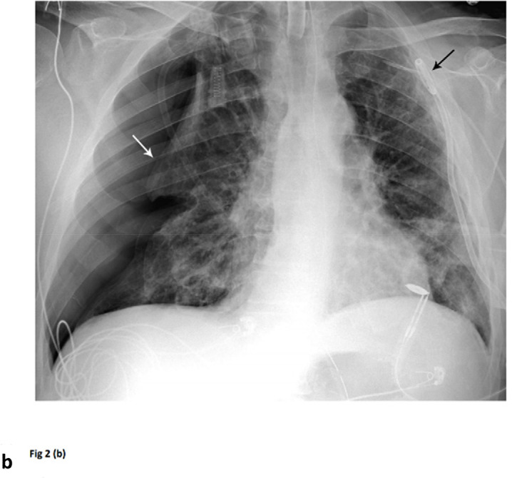 Barotrauma events separated by 14 days. 64-year-old man with diabetes and hypertension, intubated 4 days post admission. (a) Frontal chest radiograph demonstrates a large left pneumothorax 6 days after intubation (arrow). (b) He developed a large right pneumothorax 14 days later, 20 days after intubation. There is a left pleural pigtail catheter (black arrow) and re-expansion of the left lung. He underwent tracheostomy 11 days after intubation. Note hazy interstitial densities throughout his lungs.