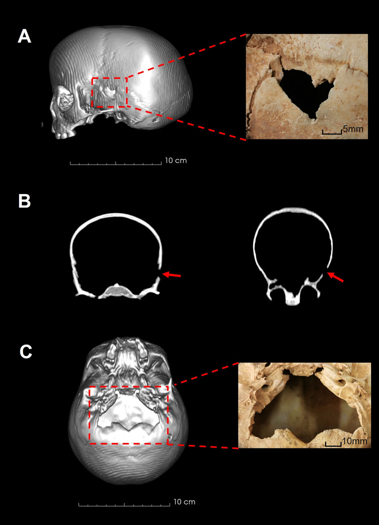 Bioarchaeology And Evidence Of Violence From A Precolonial Later Stone 