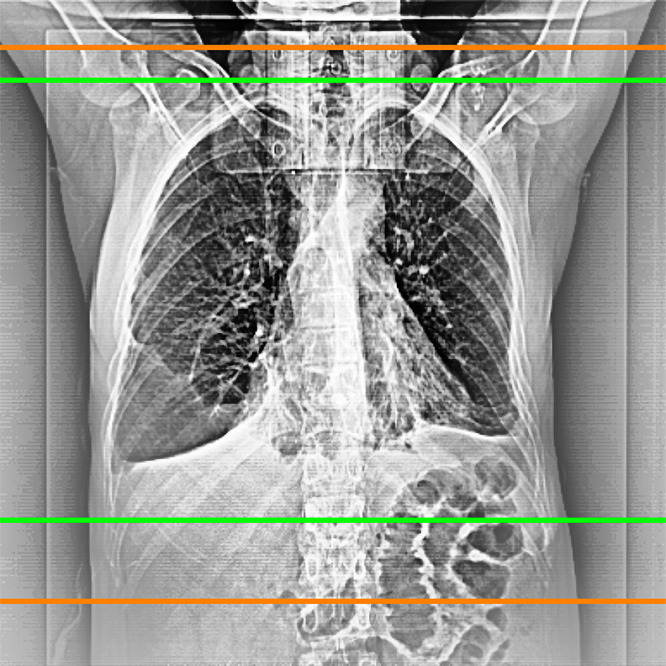 Example of a scan range limitation of radiologists (green) and radiographers (orange).