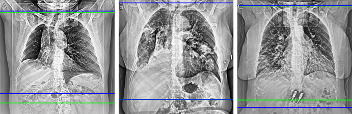 Scan range delimitations of the radiologists (green) and the network (blue) show that, A, the software-generated scan range is shorter (Dice score, 0.94), B, the scan ranges are close (Dice score, 0.99), and, C, the software-generated scan range is longer (Dice score, 0.96).