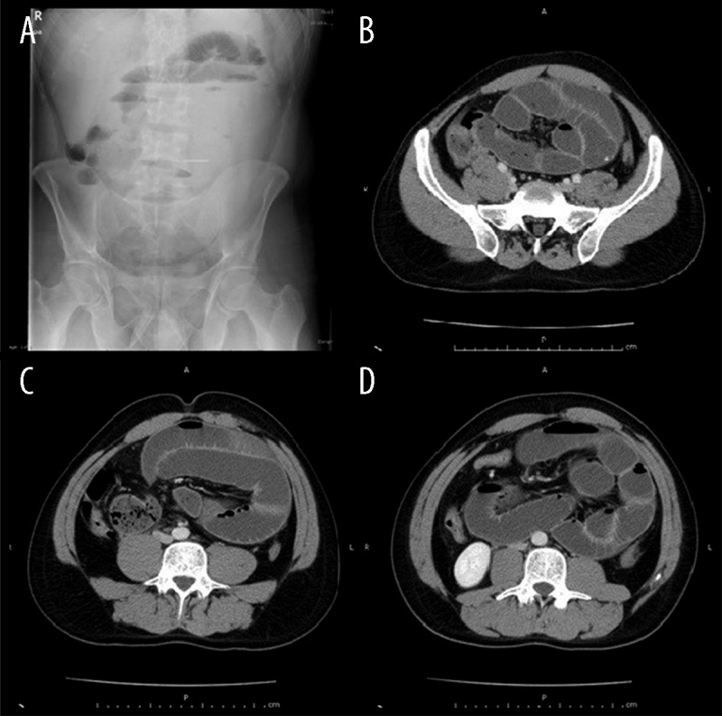 Abdominal Cocoon Syndrome is a Rare Cause of Mechanical Intestinal ...