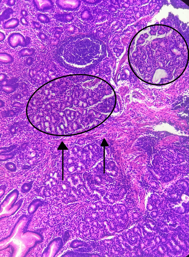 A Solitary Peutz-jeghers Hamartomatous Polyp In The Gastric Body: A 