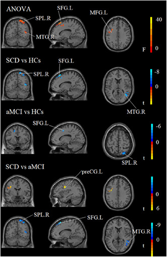 graphic file with name CNS-29-1512-g001.jpg