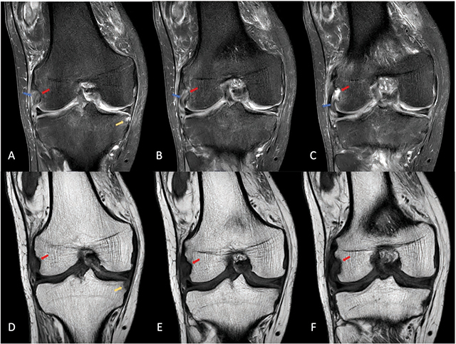 MRI of a right knee with gout showing erosions, tophi and a thickened, hyperintense popliteal tendon on proton density-weighted images