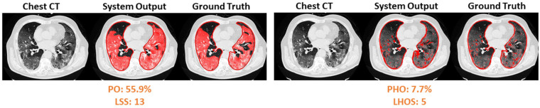 Visualization of segmented abnormality regions. (a) Combined severity measures (PO, PHO) and (LSS, LHOS) computed for six successful cases. (b) Shows the same result side by side for abnormality segmentation, and just the high opacity segmentation. (c) Shows some of the outliers of the system.