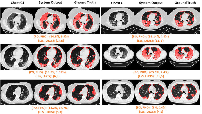 Visualization of segmented abnormality regions. (a) Combined severity measures (PO, PHO) and (LSS, LHOS) computed for six successful cases. (b) Shows the same result side by side for abnormality segmentation, and just the high opacity segmentation. (c) Shows some of the outliers of the system.