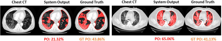 Visualization of segmented abnormality regions. (a) Combined severity measures (PO, PHO) and (LSS, LHOS) computed for six successful cases. (b) Shows the same result side by side for abnormality segmentation, and just the high opacity segmentation. (c) Shows some of the outliers of the system.