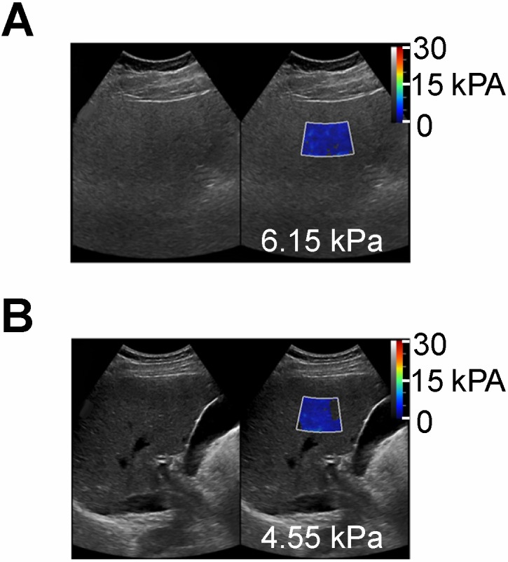 Quantitative ultrasound approaches for diagnosis and monitoring hepatic ...