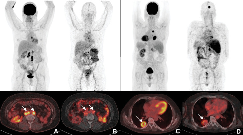 Figure 2. Heterogeneity of tracer uptake. Representative images of [18F]FDG PET/CT (left) and [89Zr]Zr-DFO-girentuximab PET/CT (right) are shown of 2 patients. In patient 1, lymph node metastases as visualized on axial sections of [18F]FDG PET/CT (A) and [89Zr]Zr-DFO-girentuximab PET/CT (B). In patient 2, lung lesions as visualized on transverse sections of [18F]FDG PET/CT (C) and [89Zr]Zr-DFO-girentuximab PET/CT (D).