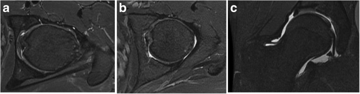 Hip pathology: the diagnostic accuracy of magnetic resonance imaging - PMC