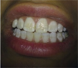 Fig. 3: Tooth Surface Index of Fluorosis (TSIF) Type 3