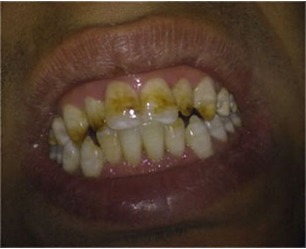 FIG 5: Tooth Surface Index of Fluorosis (TSIF) Type 5