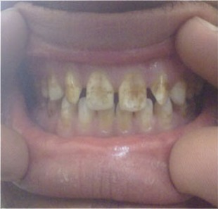 Fig 6: Tooth Surface Index of Fluorosis (TSIF) Type 6