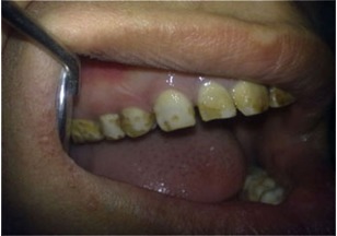 Fig 7: Tooth Surface Index of Fluorosis (TSIF) Type 7