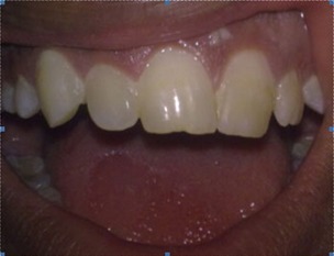 Fig. 1: Tooth Surface Index of Fluorosis (TSIF) Type 1