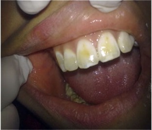 Fig. 4: Tooth Surface Index of Fluorosis (TSIF) Type 4