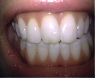 Fig. 2: Tooth Surface Index of Fluorosis (TSIF) Type 2