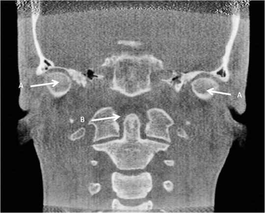 Figure 5. (A) Right and left medial condyle. (B) Dens axis in the coronal view.