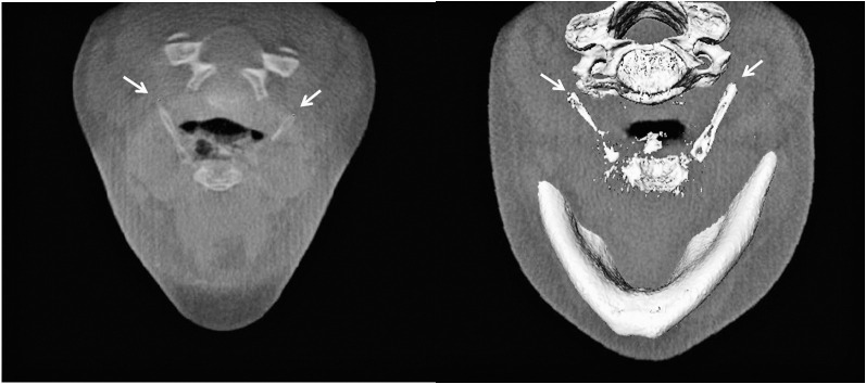 Figure 1. Posterior hyoid right, posterior hyoid left in the axial view and three-dimensional reconstruction.