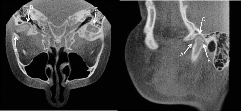 Figure 8. (A) Anterior right condyle in the axial and sagittal views. (B) Posterior right condyle in the axial and sagittal views. (C) Superior right condyle in the sagittal view.