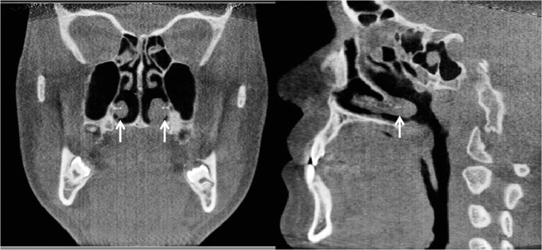 Figure 7. Posterior right and left inferior concha in the coronal view and the posterior right inferior concha in the sagittal view.