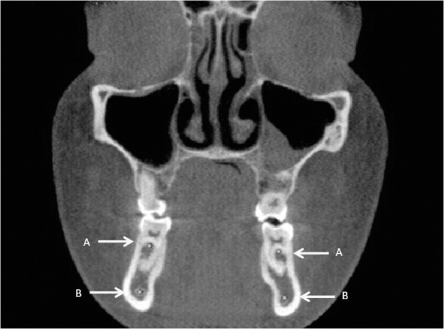 Figure 12. (A) Right and left upper first molar furca. (B) Right and left mandibular canal at first lower molar furca in the coronal view.