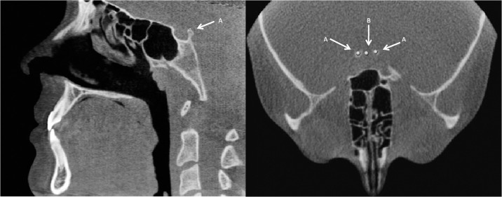 Figure 9. (A) Superior right and left clinoid processes in the axial and sagittal views. (B) Mid- clinoid in the axial view.