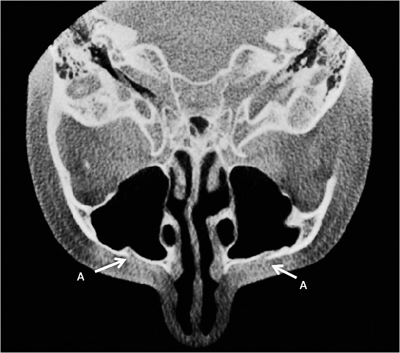 Figure 6. Right and left infraorbital foramina in the axial view.