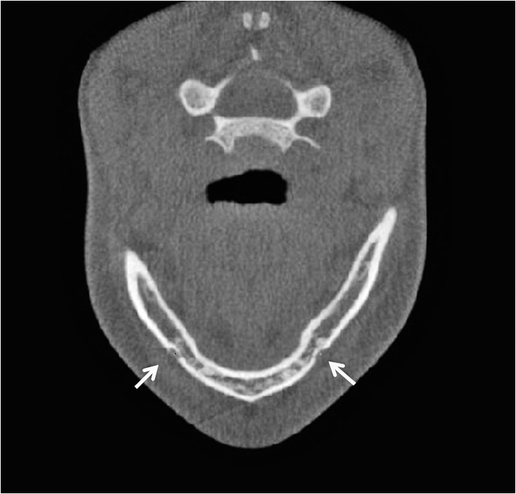 Figure 2. Mental foramen right, mental foramen left in the axial view.