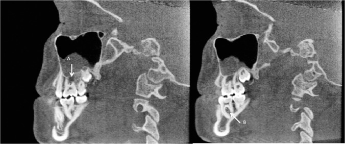 Figure 11. (A) Upper left first molar furca. (B) Lower left first molar furca in the sagittal view.