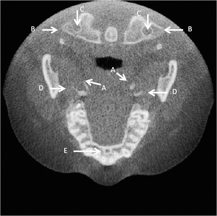 Figure 4. (A) Right and left inferior medial pterygoid plate. (B) Right and left transverse process atlas. (C) Right and left transversarium atlas. (D) Right and left inferior lateral pterygoid plate. (E) Oral incisive foramen in the axial view.