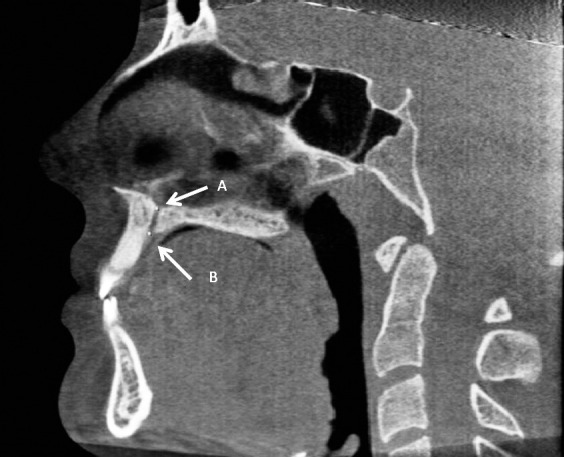 Figure 10. (A) Nasal incisive orifice. (B) Oral incisive foramen in the sagittal view.