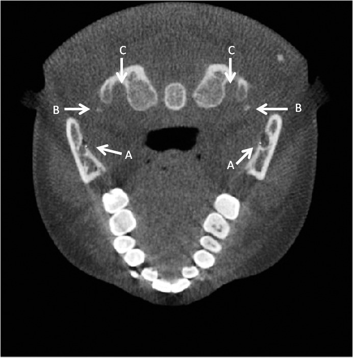 Figure 3. (A) Lingula right and left. (B) Right and left transversarium atlas. (C) Right and left inferior styloid process in the axial view.