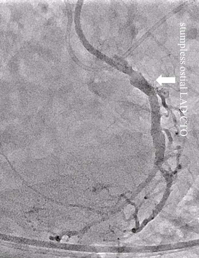 A Novel Strategy for Chronic Total Occlusion of the Stumpless Ostial ...