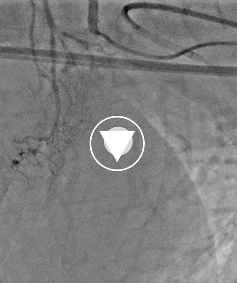 A Novel Strategy for Chronic Total Occlusion of the Stumpless Ostial ...