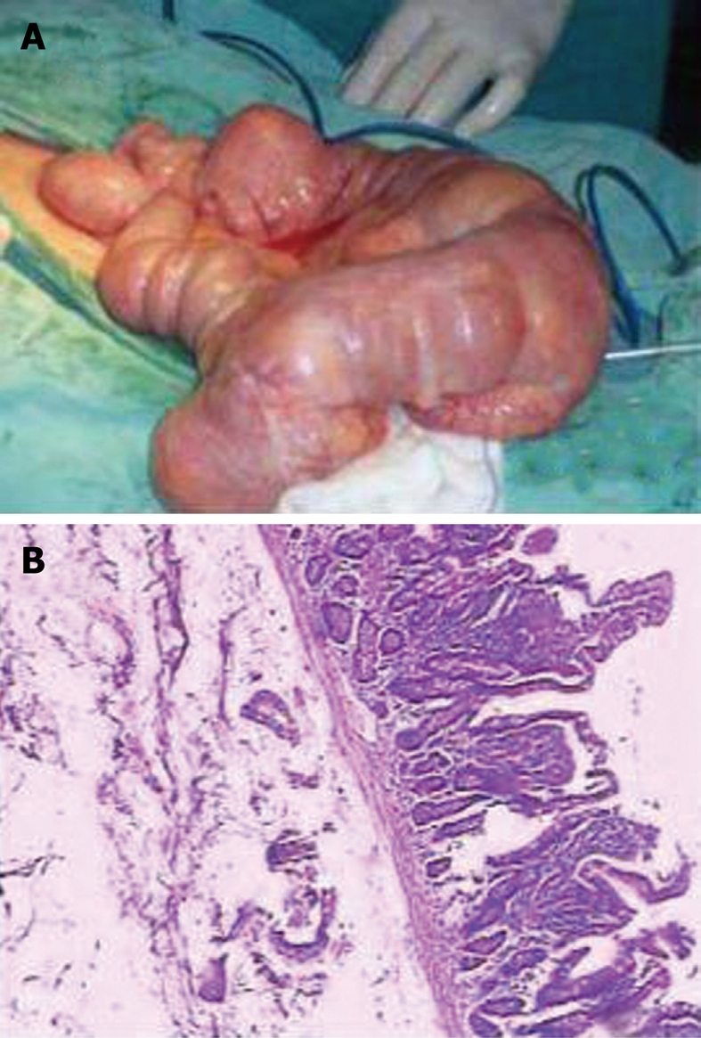 partial-intestinal-obstruction-secondary-to-multiple-lipomas-within