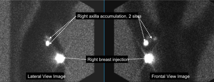 Images obtained from a lymphoscintigraphy examination. Following the injection of a radioactive tracer into one or both breasts, images are obtained with a gamma camera in anterior and lateral projections. Bright areas are sites of injection or radiotracer accumulation in lymph nodes where breast cancer may have spread. In the current example, there was an injection to the right breast, with two sites of accumulation in the right axilla.