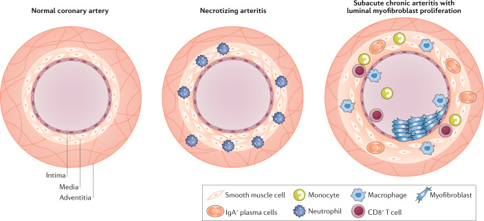 Kawasaki disease: pathophysiology and insights from mouse models - PMC