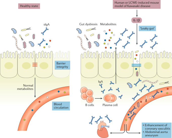 Kawasaki disease: pathophysiology and insights from mouse models - PMC