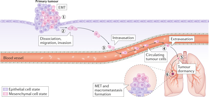 Box 1 The metastasis cascade