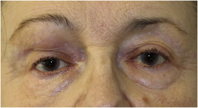 Diagnosis and treatment of upper eyelid lipoma: A case report - PMC