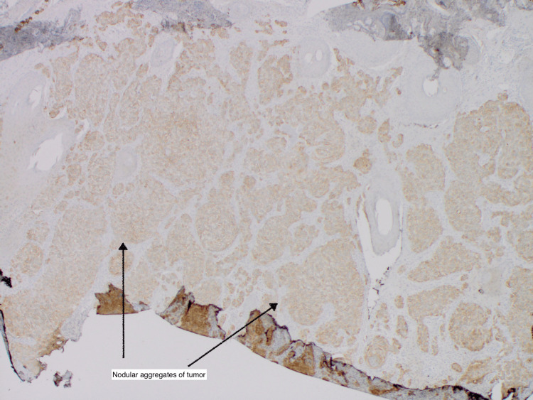 Adnexal Clear Cell Carcinoma Exhibiting Comedonecrosis Of The Ear A Rare Case Treated With Mohs 6430