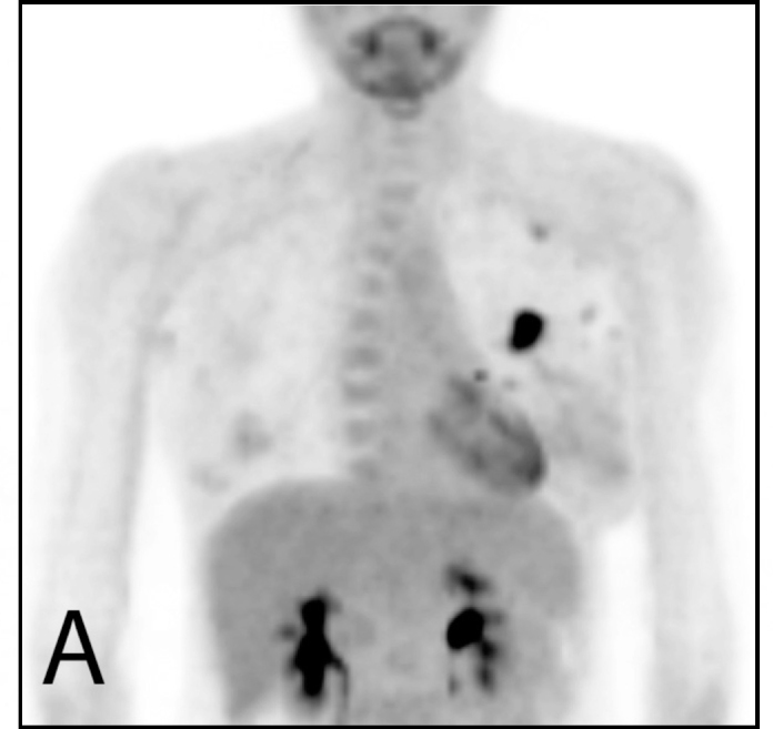 Nonvisualization of sentinel node by lymphoscintigraphy in advanced