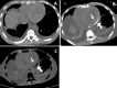 Images in a 30-year-old man with end-stage renal disease who developed dystrophic myocardial calcifications in the left heart within 13 weeks. A, Prior axial non–contrast-enhanced chest CT scan with absence of myocardial calcifications. B, Axial non–contrast-enhanced chest CT scan acquired 93 days later shows interval development of calcium deposition within the lateral wall of the left ventricle and papillary muscle (arrows). C, Dual-energy CT scan with calcium-suppression demonstrates low attenuation confirming the presence of calcium deposition in the left ventricle and papillary muscle (arrows).