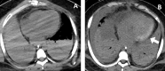 Images in a 20-year-old man with history of trisomy 21 and recent diagnosis of COVID-19 pneumonia with development of dystrophic myocardial calcifications in the left heart within 5 weeks. A, Axial non–contrast-enhanced chest CT scan with no evidence of myocardial calcifications. B, Axial non–contrast-enhanced chest CT scan obtained 40 days later shows dystrophic deposition of calcium in the left ventricular lateral wall myocardium (arrow).