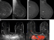 Images in a 67-year-old woman with triple receptor–negative
invasive ductal carcinoma (IDC) seen only at contrast-enhanced mammography
(CEM) at year 2. (A) Left craniocaudal (CC) (left) and mediolateral oblique
(MLO) (right) low-energy images show scattered fibroglandular density and
postsurgical scarring, with clips in the lower inner quadrant at the site of
lumpectomy for a 2.1-cm grade 3 IDC, estrogen receptor– and
progesterone receptor–positive and human epidermal growth factor
receptor 2 (HER2) (ERBB2 gene)–negative lesion 11 years prior.
Scattered benign-appearing calcifications are noted. The participant also
completed radiation therapy and adjuvant chemotherapy and was treated with
tamoxifen for 7 years and then with an aromatase inhibitor for 3 years, with
last use 1 year prior to study entry. (B) Recombined CC (left) and MLO
(right) CEM images obtained in year 2 show moderately conspicuous
enhancement of an oval mass in the upper outer left breast (arrows), which
was new from the prior CEM examination (not shown). This lesion was assessed
as Breast Imaging Reporting and Data System (BI-RADS) 4B, moderately
suspicious, by observer 1 and as BI-RADS 3, probably benign, but recommended
for additional evaluation, by observer 2. At the time, CEM-guided biopsy was
not available, so the participant underwent MRI and MRI-guided biopsy. (C)
Axial maximum intensity projection from T1-weighted fat-suppressed MRI
(left) shows moderately intense enhancement of the same mass (arrow), with
plateau and washout kinetics (arrow) on axial post-contrast fat-suppressed
T1-weighted image with kinetic overlay (right). MRI-guided biopsy and
excision revealed a 0.5-cm grade 3 IDC, triple receptor–negative
lesion (Ki-67 proliferation index of 55%). Three sentinel nodes were
negative for metastasis.
