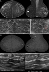Images in a 77-year-old woman with invasive ductal carcinoma (IDC)
seen only at contrast-enhanced mammography (CEM) and ductal carcinoma in
situ (DCIS) seen only on low-energy (LE) images and digital breast
tomosynthesis images at year 2. (A) Bilateral craniocaudal (CC) (left) and
mediolateral oblique (MLO) (right) LE images show heterogeneously dense
parenchyma and postsurgical changes with dystrophic calcifications in the
upper right breast and clips in the right axilla from breast-conserving
therapy for a grade 1 IDC, estrogen receptor (ER)– and progesterone
receptor (PR)–positive, human epidermal growth factor receptor 2
(HER2) (ERBB2 gene)–negative, 19 years earlier, for which she had
taken Anastrozole for 4 years. Only observer 1 recalled the participant for
linear calcifications in the left breast (arrows), which are better seen on
(B) close-up CC (left) and MLO (right) LE images (arrows) and (C) a spot
magnification CC view of the central left breast. In addition to typically
benign calcifications more laterally and fine linear calcifications (arrow
in C), seen only on C more anteriorly, there is a group of amorphous
calcifications (circle in C). Both areas of calcification were recommended
for biopsy, despite lack of enhancement on (D) recombined CC (left) and MLO
(right) CEM images. A moderately conspicuous enhancing mass in the
retroareolar left breast was newly seen, which was only evident at CC CEM
(arrow in D) and was assessed as Breast Imaging Reporting and Data System
(BI-RADS) 4A, low suspicion, by observer 1 and as BI-RADS 4B, moderate
suspicion, by observer 2. (E) CEM-directed US images (left = transverse
plane, right = longitudinal plane) of the retroareolar left breast show an
irregular, hypoechoic mass (arrows) with an echogenic rim, highly suggestive
of malignancy (BI-RADS 5). US-guided core biopsy and mastectomy revealed a
2.1-cm grade 3 ER and PR-positive, ERBB2-negative IDC. Stereotactic biopsy
of the linear calcifications revealed high-grade ER and PR-positive DCIS,
and biopsy of the amorphous calcifications yielded atypical ductal
hyperplasia. At mastectomy, 5.5 cm of high-nuclear-grade DCIS was found,
discontinuous with the retroareolar IDC. One of two sentinel nodes showed
isolated tumor cells (N0).